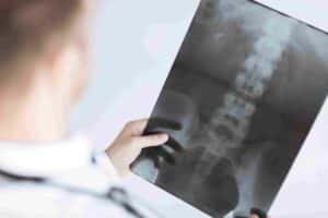 Spinal Cord Injury Lawyer